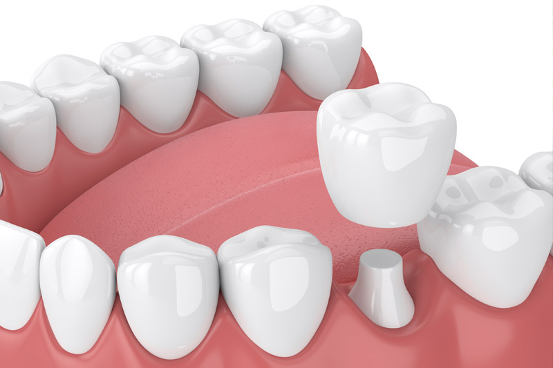 Dental Crowns in Tomball