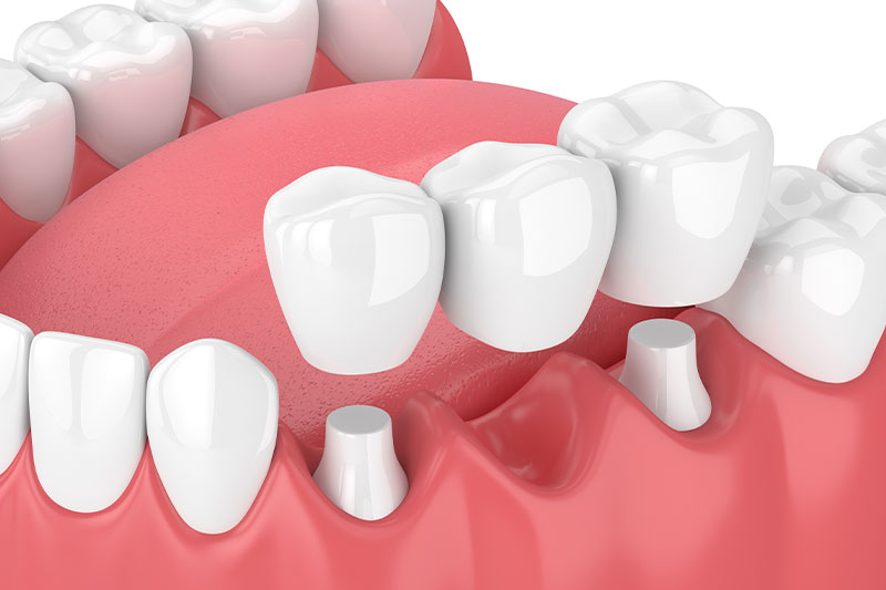 Dental Bridges in Tomball