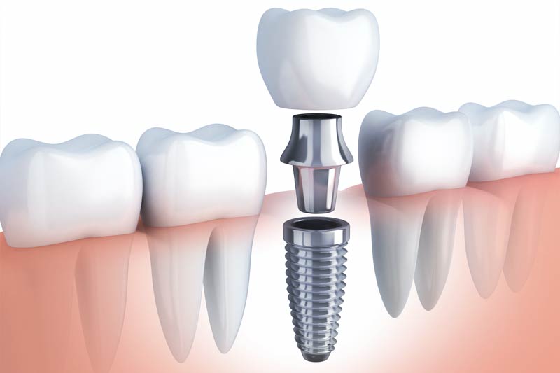 Implants Dentist in Tomball