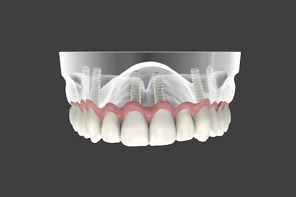 Are Implant Supported Dentures Permanent from Heather Feray Bohan, DDS, PA in Tomball, TX