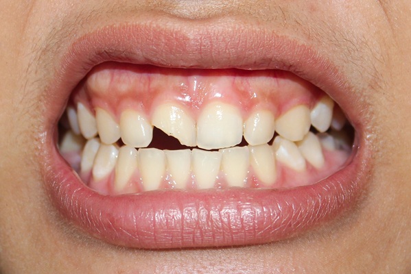 When Is A Broken Tooth A Dental  Emergency?