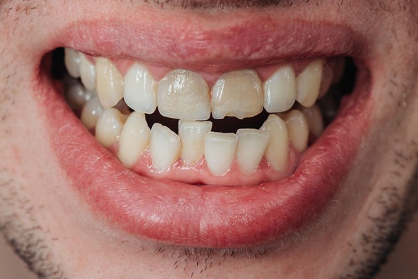 Why Is It Important To Get A Chipped Tooth Repaired?