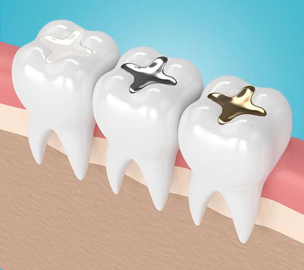 Tomball Composite Fillings