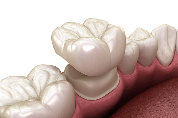 What Can Dental Crowns Do for Your Oral Health Issues? from Heather Feray Bohan, DDS, PA in Tomball, TX