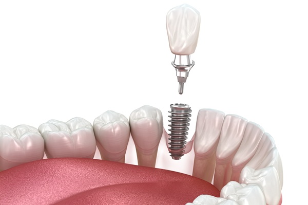 The Dental Implant Restoration Procedure
