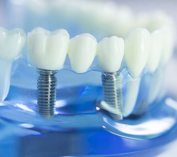 Tomball Dental Implants
