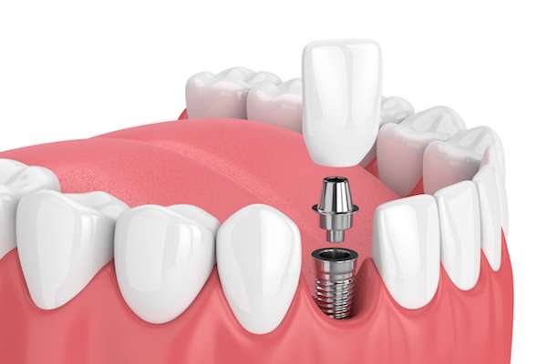 How Painful is Dental Implant Surgery from Heather Feray Bohan, DDS, PA in Tomball, TX