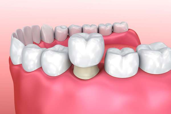 Permanent Dental Crowns vs. Temporary: Is There a Difference from Heather Feray Bohan, DDS, PA in Tomball, TX