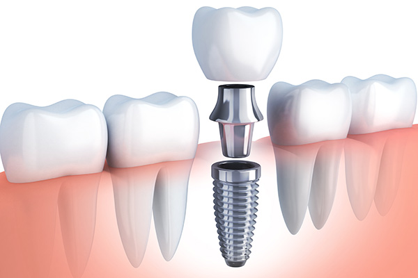 Questions to Ask Your Implant Dentist from Heather Feray Bohan, DDS, PA in Tomball, TX